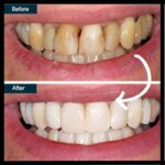 Teeth Whitening service in whitefield