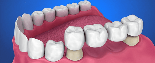 Dental crowns cost in whitefield