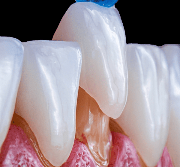 Dental crowns cost in whitefield