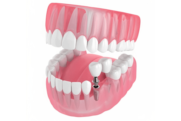 Cost effective dental implants in whitefield