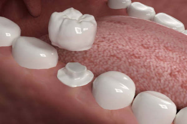 Dental crowns cost in whitefield
