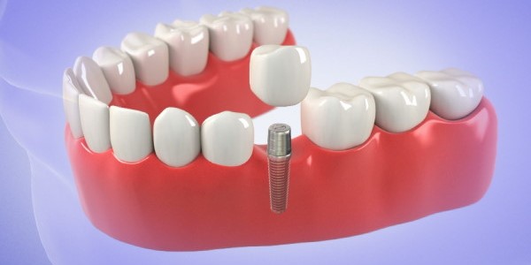 Cost effective dental implants in whitefield