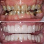 Dental crowns cost in whitefield