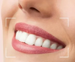 Teeth Whitening service in whitefield